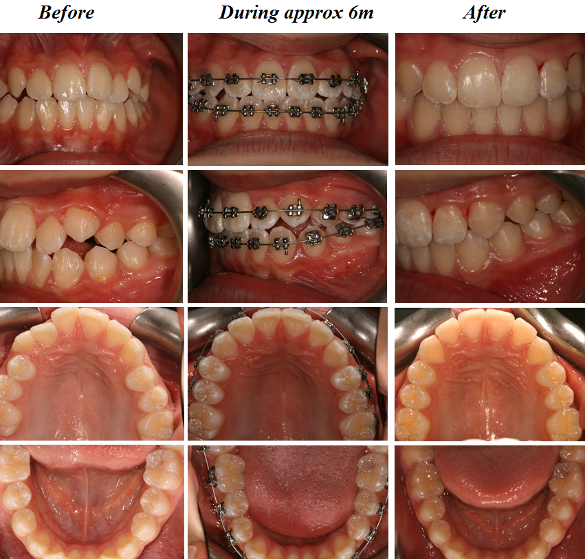 Aesthetic Dental Zone Ortho Before During and After