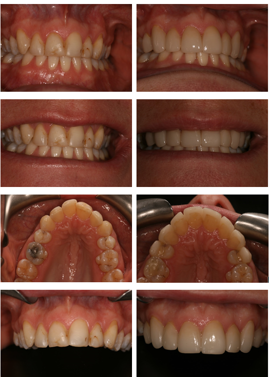 Aesthetic Dental Zone Veeners