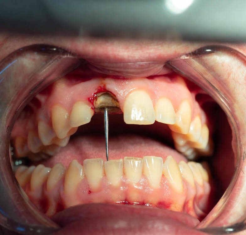 Root Canal Front Tooth