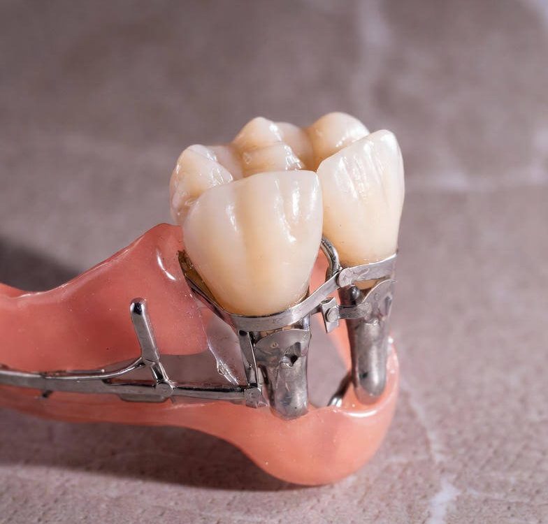 single tooth denture