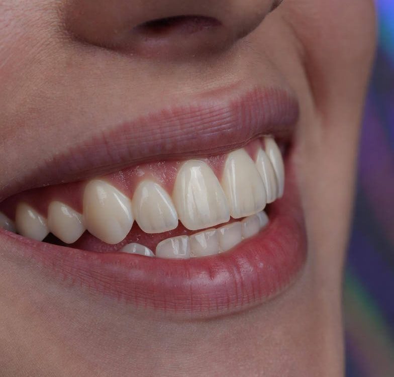 dental veneers