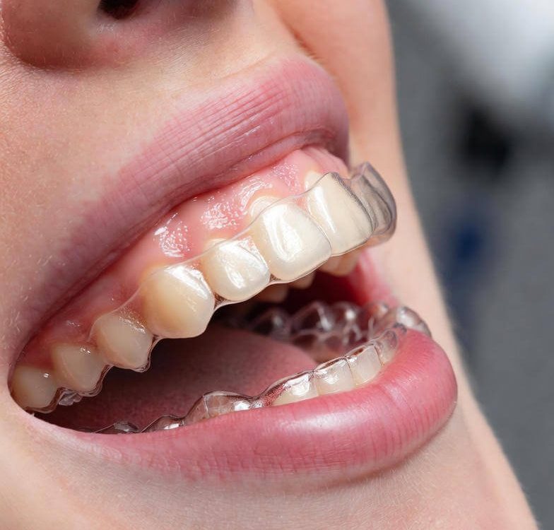 invisalign in dulwich