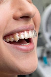 invisalign in dulwich