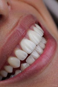 dental veneers 