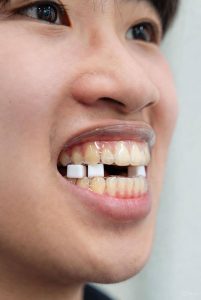 how to chew with bite blocks