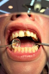 Root Canal Front Tooth