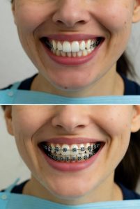 ceramic braces