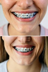 ceramic braces