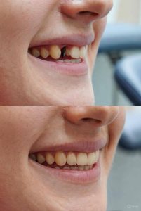 cheapest dental implants dulwich