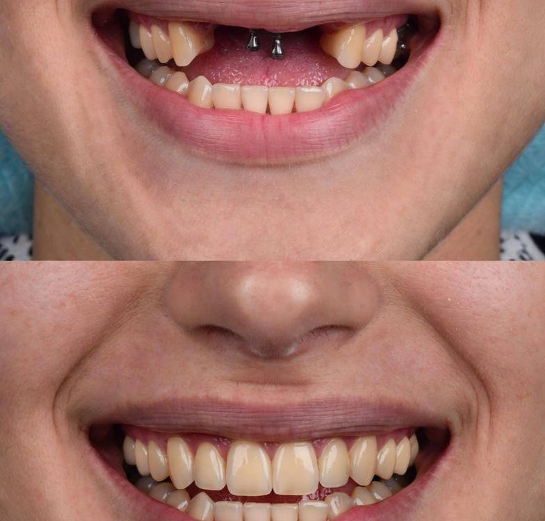 cheapest dental implants dulwich