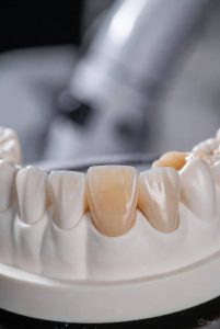 cerec crown