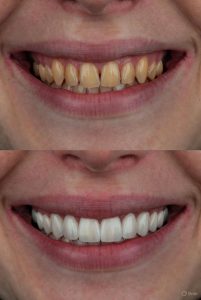 dental veneers