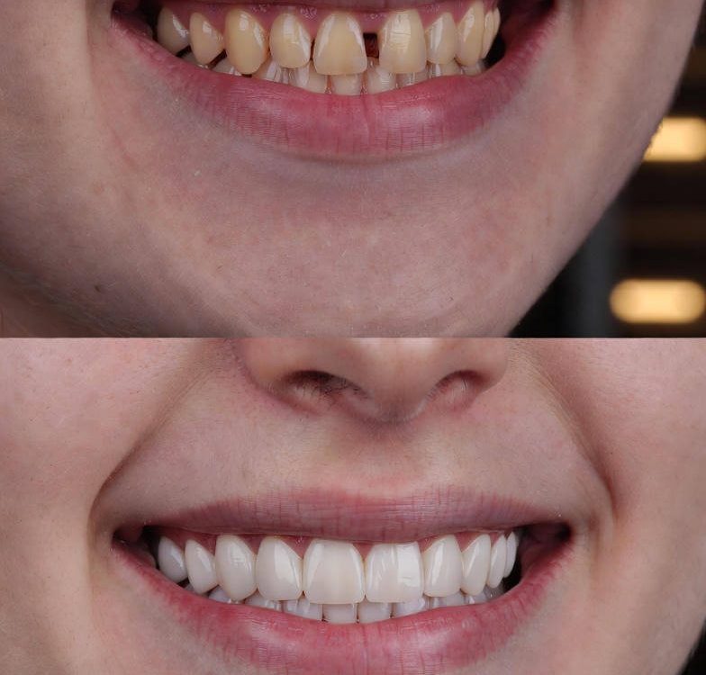 dental veneers