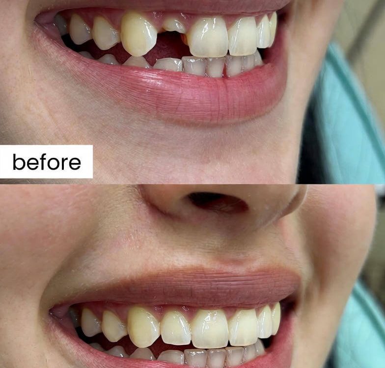 teeth filler for gaps