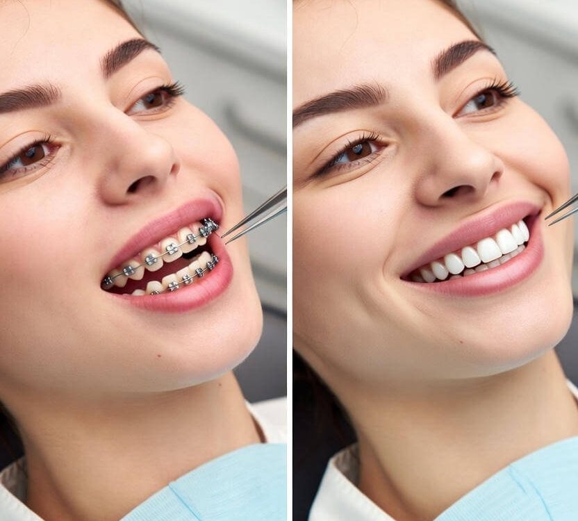 orthodontic treatment