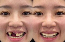 Mini Dental Implants in Dulwich