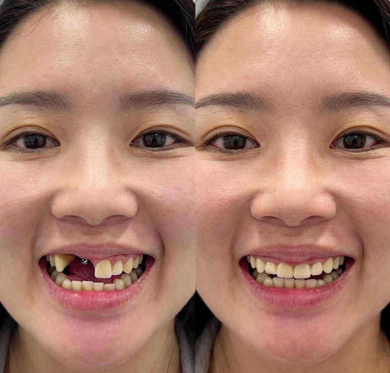 mini dental implants