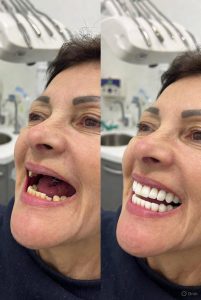 mini dental implants