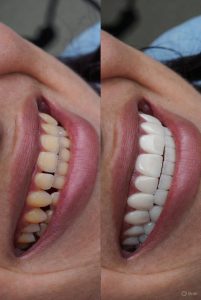 veneer teeth shaving