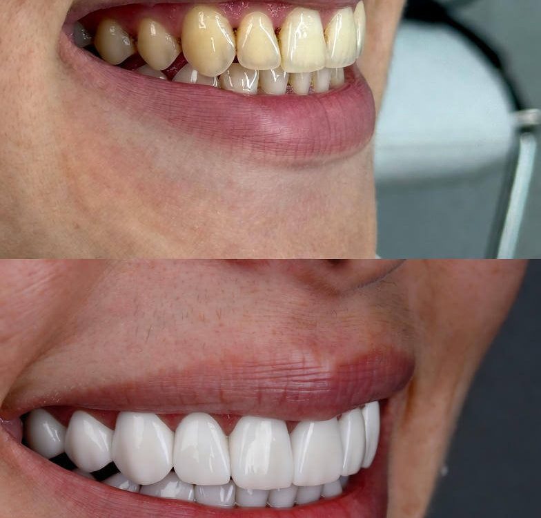 veneer teeth shaving
