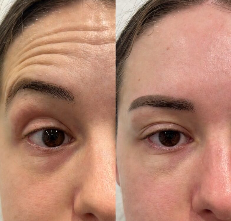 botox before and after