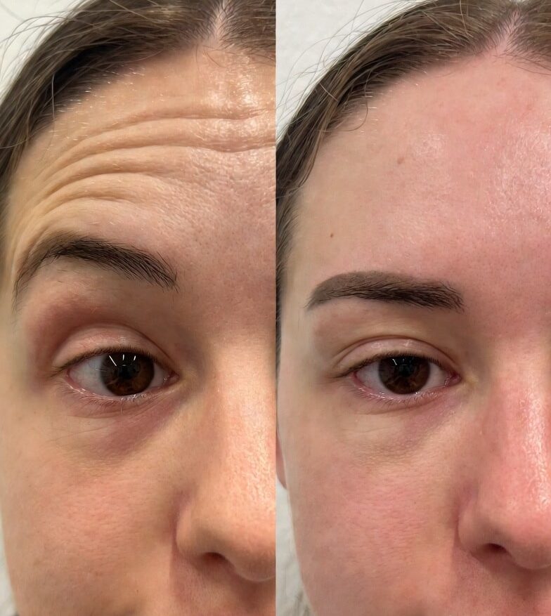 botox before and after