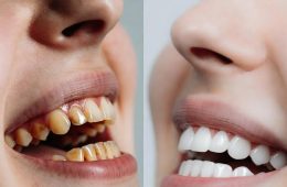 Teeth Hygiene Clean A Complete Guide